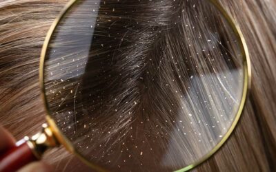 10 Natural Remedies for Dandruff